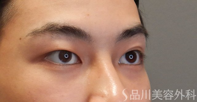 症例NO.74603のBEFORE写真
