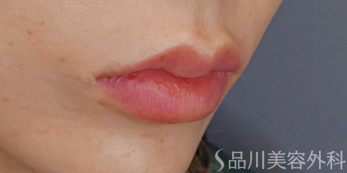 症例NO.72195のAFTER写真