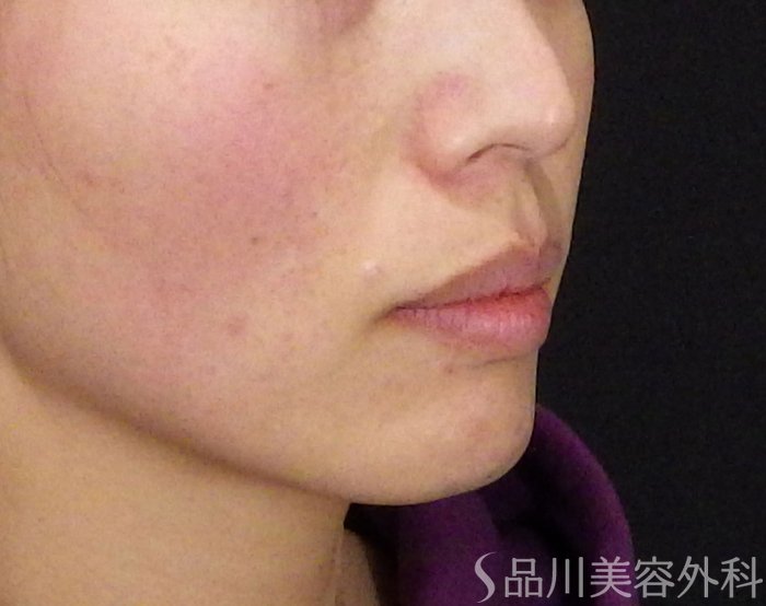 症例NO.71106のBEFORE写真