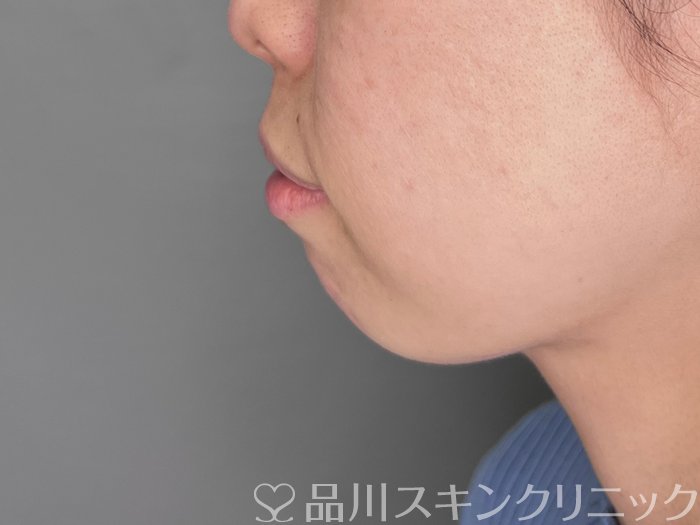 症例NO.69762のBEFORE写真