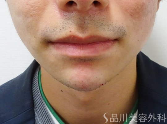症例NO.71141のAFTER写真