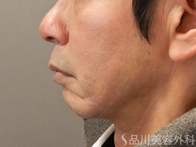 症例NO.73876のBEFORE写真
