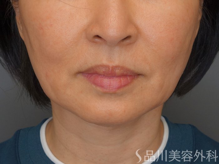 症例NO.70074のBEFORE写真