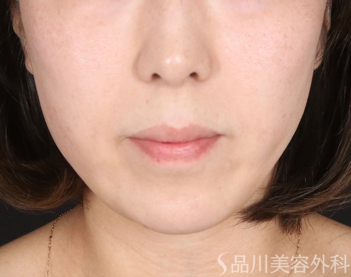 症例NO.72625のAFTER写真