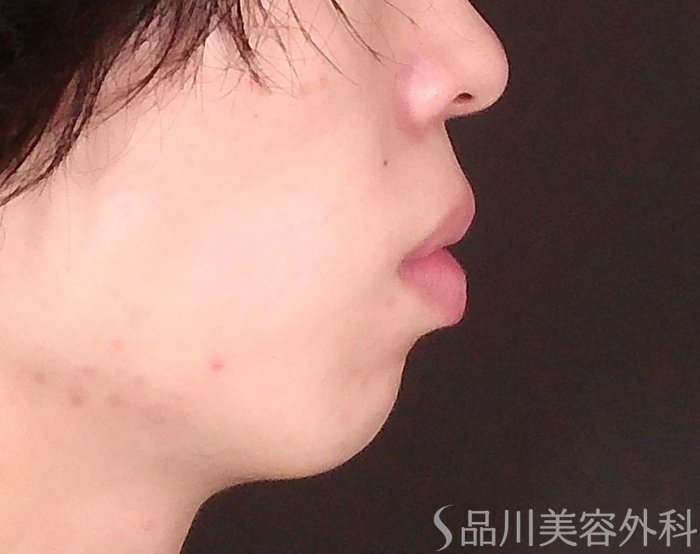 症例NO.70093のBEFORE写真
