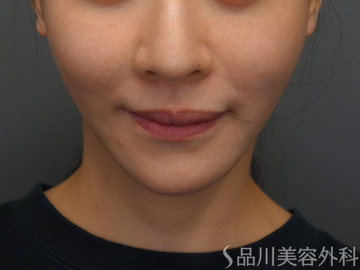 症例NO.74408のBEFORE写真