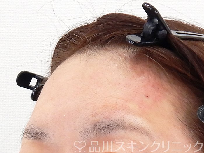 症例NO.62192のAFTER写真