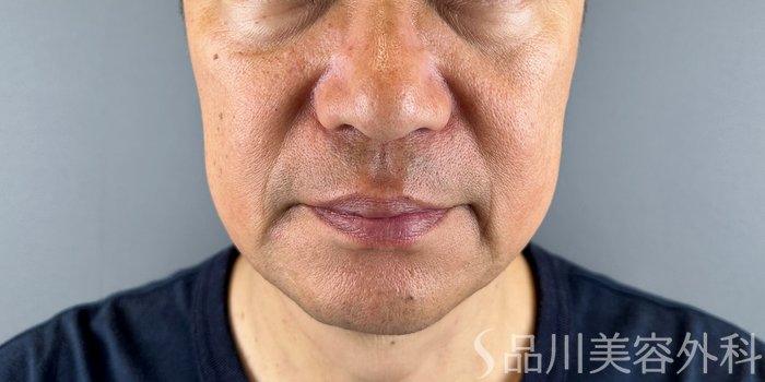 症例NO.68603のBEFORE写真