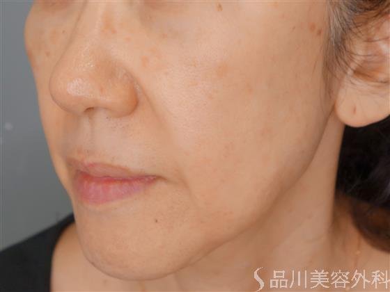 症例NO.53352のBEFORE写真