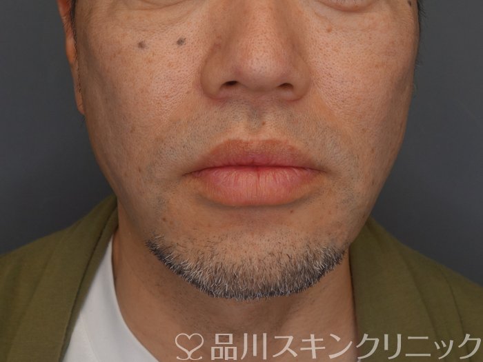 症例NO.74257のAFTER写真