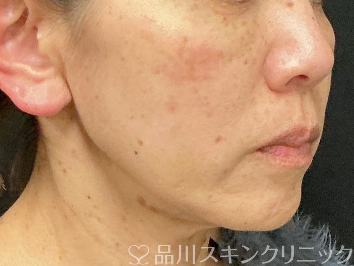 症例NO.73583のBEFORE写真