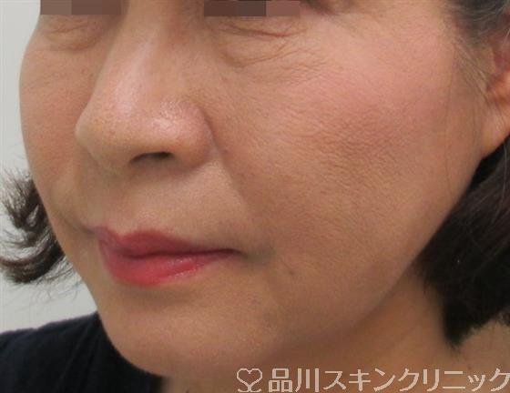 症例NO.26429のAFTER写真