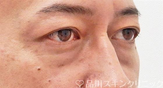 症例NO.61695のBEFORE写真