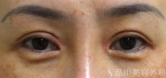症例NO.47404のAFTER写真