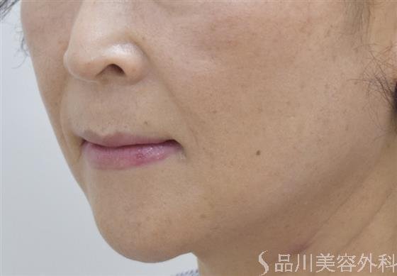 症例NO.49182のBEFORE写真
