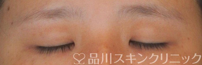 症例NO.64312のBEFORE写真