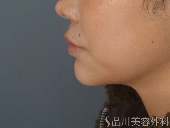 症例NO.72470のAFTER写真