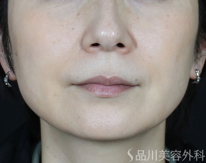 症例NO.72095のBEFORE写真