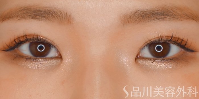 症例NO.70013のAFTER写真