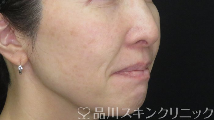症例NO.71677のBEFORE写真