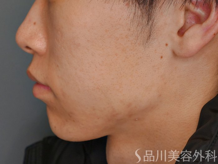症例NO.73514のAFTER写真