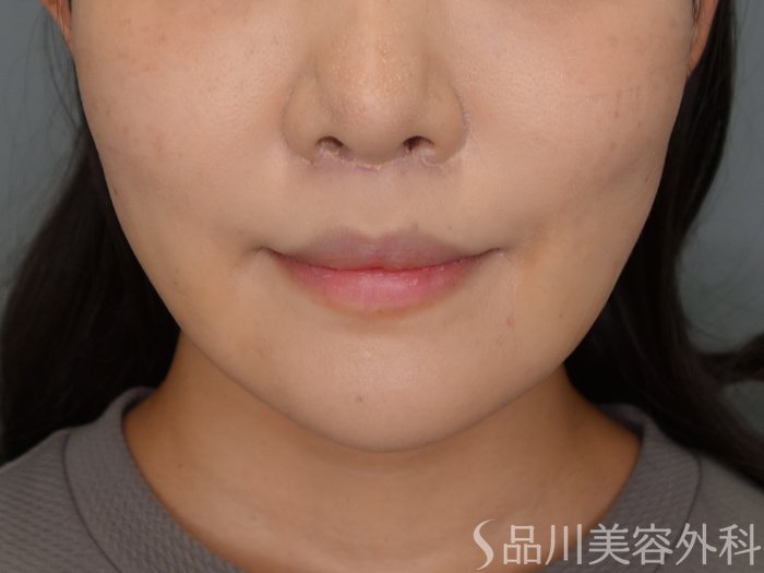 症例NO.69725のBEFORE写真