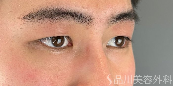 症例NO.69284のBEFORE写真