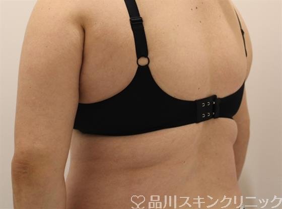 症例NO.47406のAFTER写真