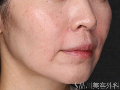 症例NO.72964のAFTER写真