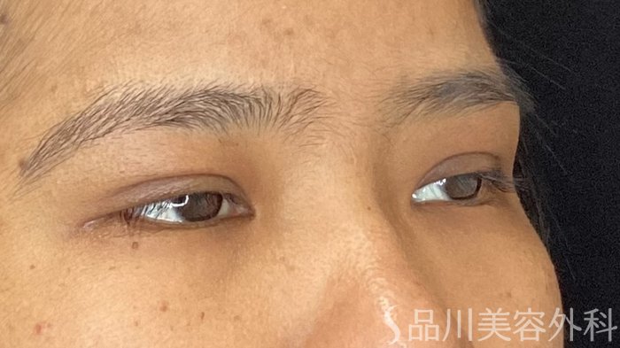 症例NO.72198のAFTER写真