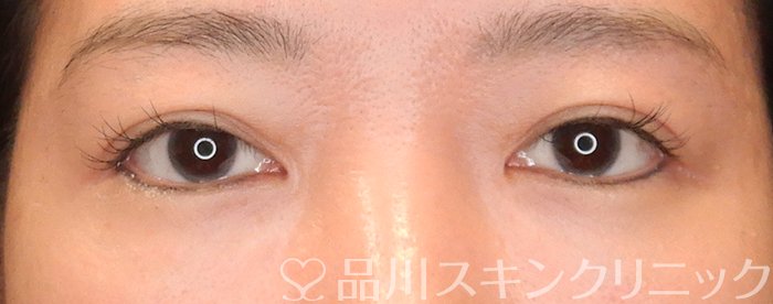 症例NO.65534のAFTER写真