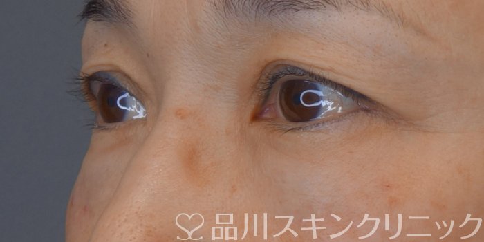 症例NO.74249のAFTER写真