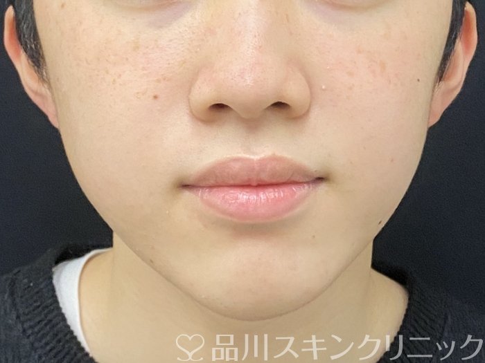 症例NO.73946のAFTER写真