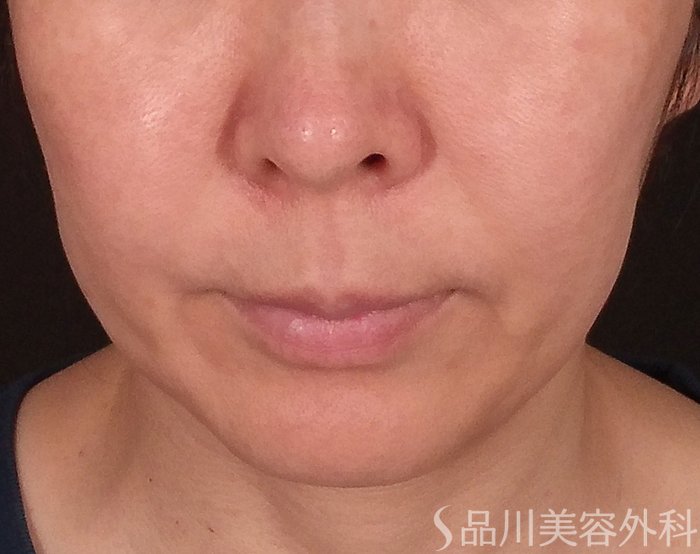 症例NO.70212のBEFORE写真
