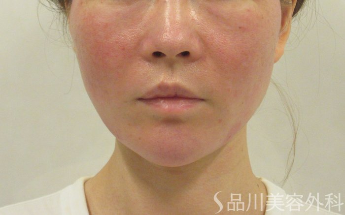 症例NO.72166のAFTER写真