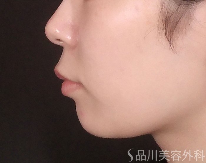 症例NO.70667のBEFORE写真