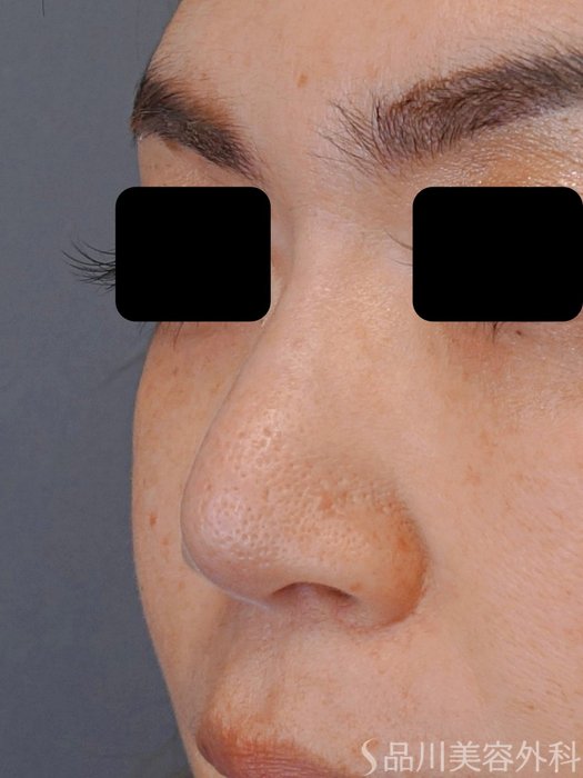症例NO.74171のBEFORE写真