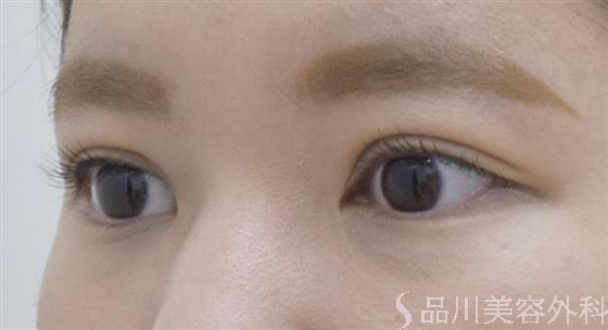症例NO.52539のAFTER写真