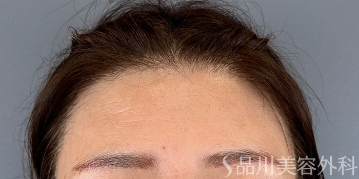 症例NO.73139のBEFORE写真