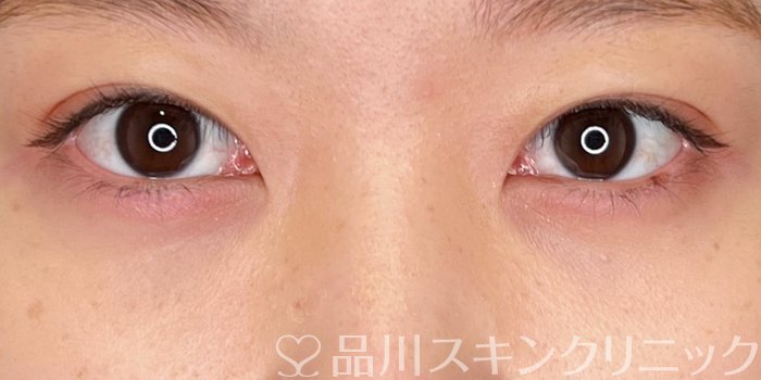 症例NO.69879のAFTER写真
