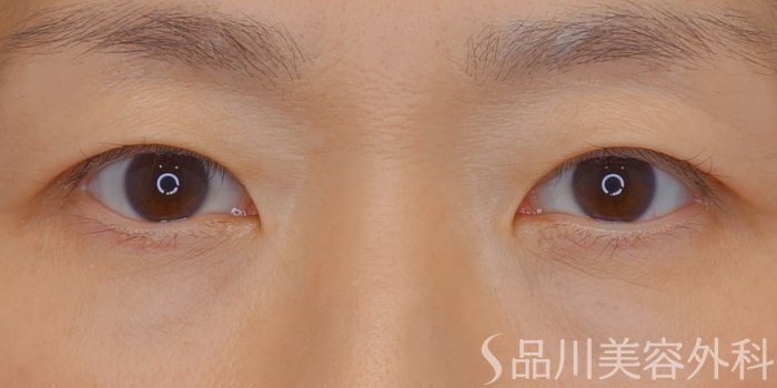 症例NO.73988のAFTER写真