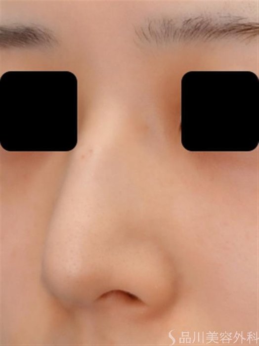 症例NO.51739のBEFORE写真