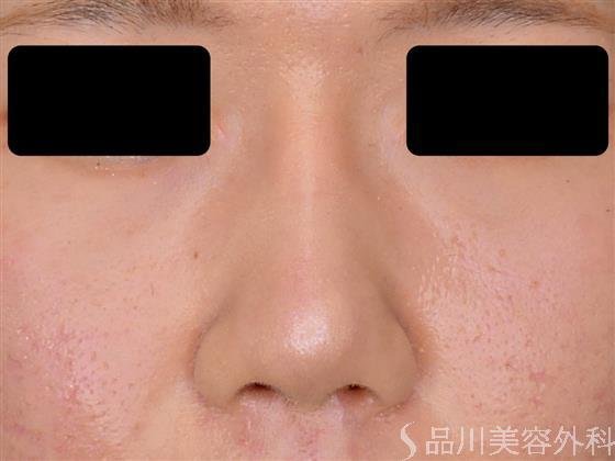 症例NO.55275のAFTER写真