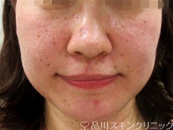 症例NO.30042のBEFORE写真