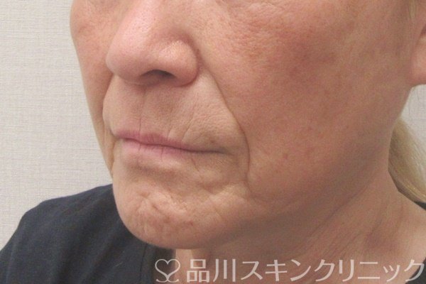 症例NO.70880のBEFORE写真