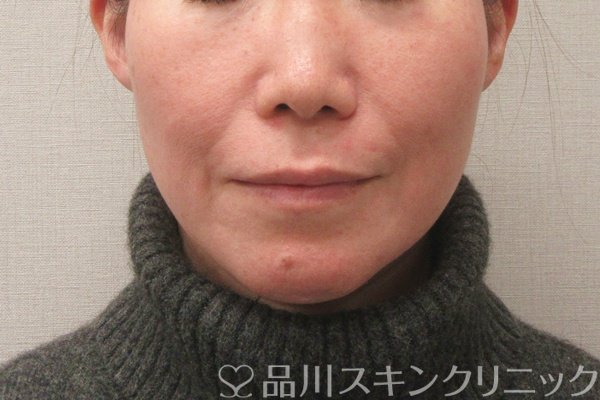 症例NO.75393のBEFORE写真
