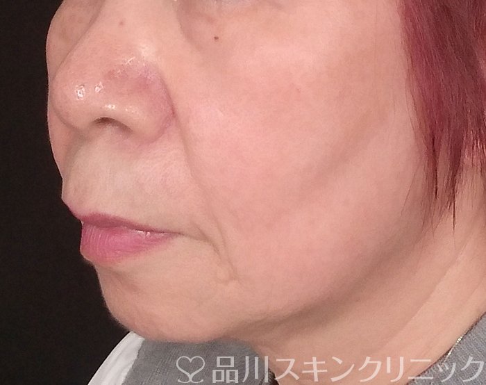 症例NO.69742のBEFORE写真