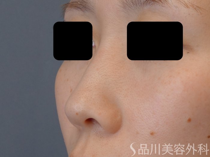 症例NO.72974のBEFORE写真