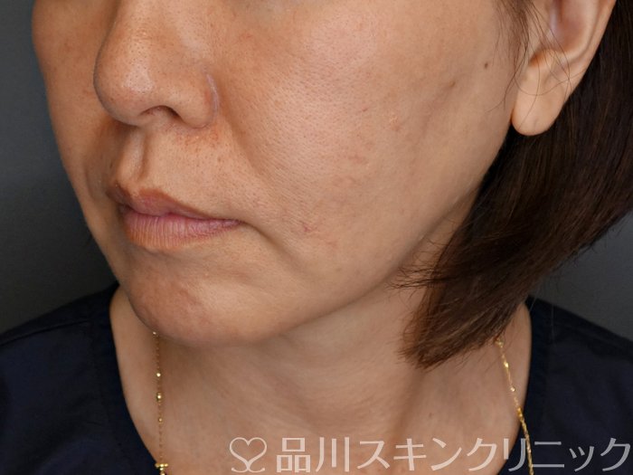 症例NO.71298のBEFORE写真