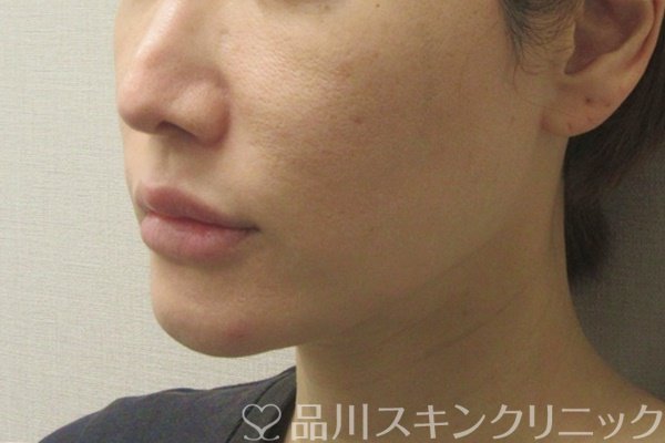 症例NO.73067のBEFORE写真